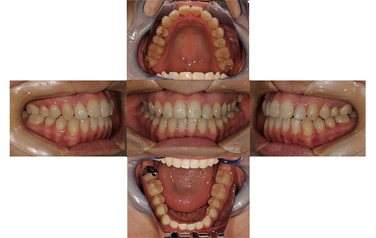叢生　非抜歯ケース　治療前