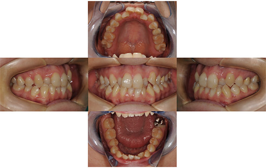 叢生 非抜歯ケース　治療前