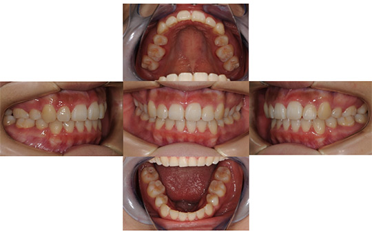 叢生　抜歯ケース　治療前
