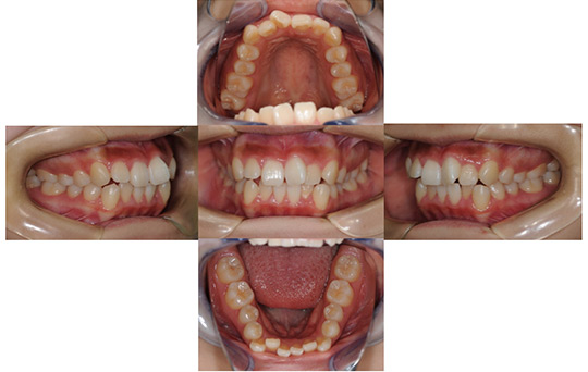 叢生 抜歯ケース　治療前