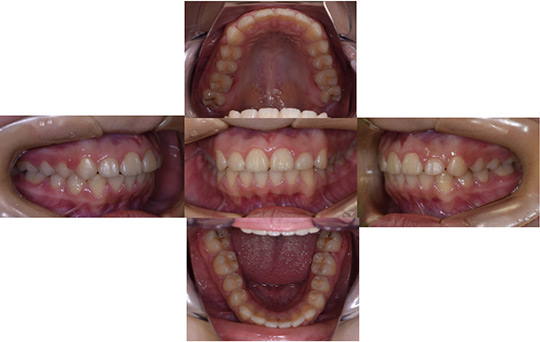 前突　非抜歯ケース　治療前