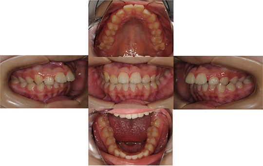 前突　非抜歯ケース　治療前