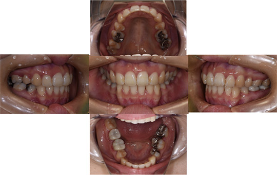 前突　抜歯ケース　治療前
