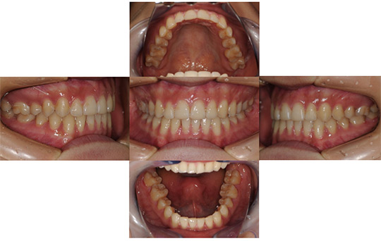 すきっ歯　非抜歯ケース　治療前