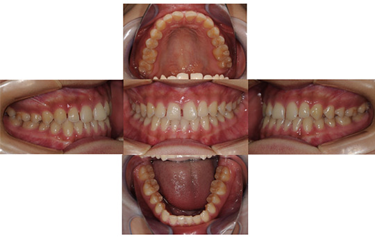 すきっ歯 非抜歯ケース　治療前