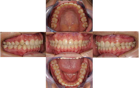 過蓋咬合　非抜歯ケース　治療前