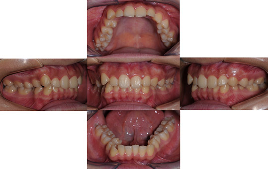 過蓋咬合 非抜歯ケース　治療前