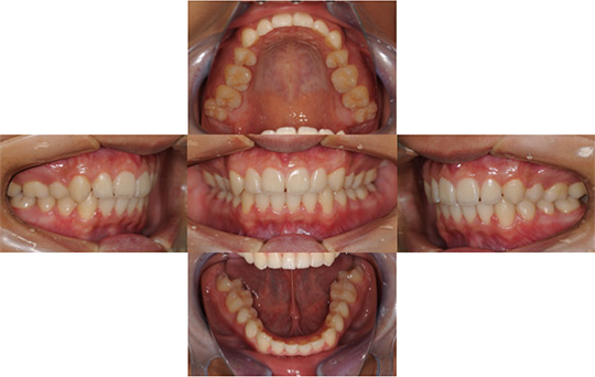 過蓋咬合　非抜歯ケース　治療前