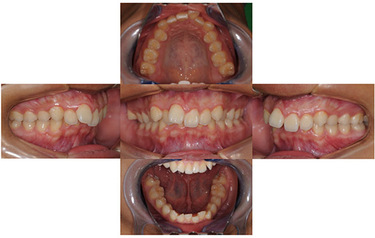 過蓋咬合 非抜歯ケース　治療前
