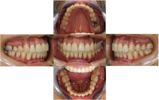 開咬　非抜歯ケース　治療前