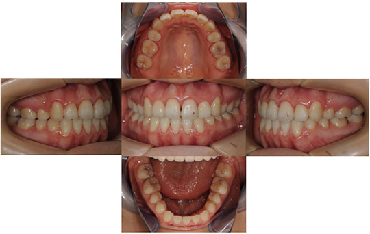 開咬　抜歯ケース　治療前