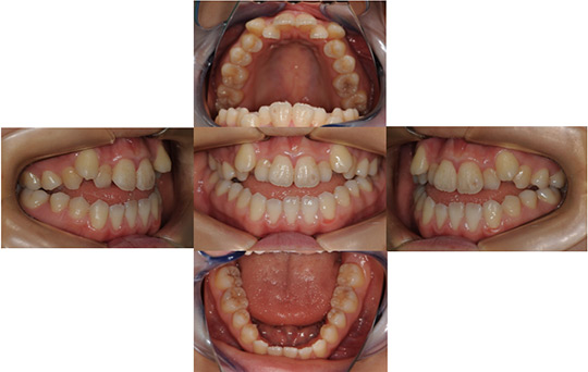 開咬 抜歯ケース　治療前