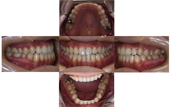受け口（反対咬合）　非抜歯ケース　治療前