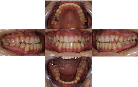 受け口（反対咬合） 非抜歯ケース　治療前