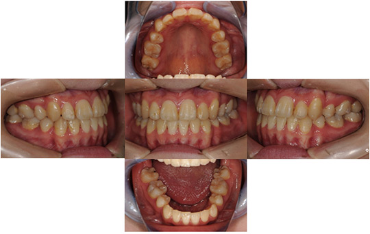 受け口（反対咬合）　抜歯ケース　治療前