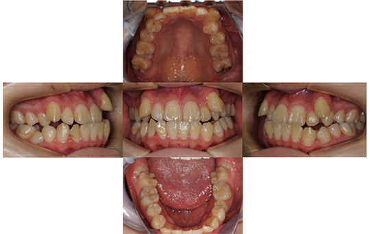 受け口（反対咬合） 抜歯ケース　治療前