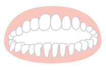 開咬（前歯が咬み合わない）