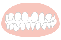 すきっ歯（空隙歯列-クウゲキシレツ）